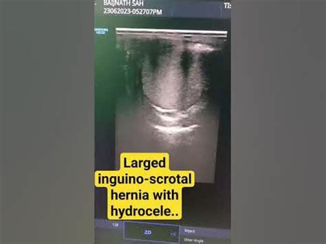 inguino scrotal hernia orchiectomy